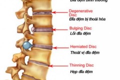Gai xương cột sống thắt lưng, một biểu hiện của thoái hóa cột sống
