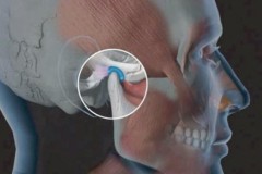 Biểu hiện và cách điều trị loạn năng thái dương hàm