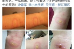 Một người dùng tại Trung Quốc bị bỏng do Xiaomi Mi Band 2 đột nhiên bốc cháy