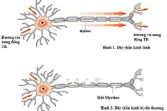 Liệt cơ tức thời bởi hội chứng Guillain - Barré