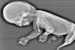 Thai nhi mọc đuôi như nàng tiên cá trong bụng mẹ