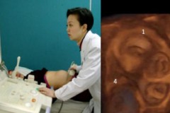 Thai phụ 30 tuổi phát hiện ‘dị thai’, thế giới chỉ có duy nhất 2 trường hợp