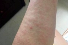 Cẩn trọng bệnh về da do đi mưa và lội nước ngập