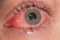 Phát hiện kinh ngạc: Virus Zika có thể sống trong mắt người