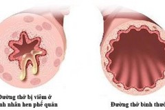 6 lời khuyên giúp phòng hen phế quản khi giao mùa