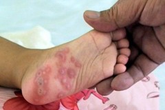 Bệnh tay chân miệng vào mùa: Những điều cần biết
