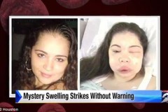 Bí hiểm căn bệnh đột biến gene khiến cơ thể người to gấp đôi