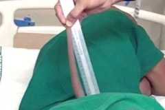 Chuyện lạ: Nam thanh niên "sót" chiếc đuôi dài gần 18cm