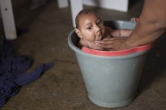 Dấu hiệu nhận biết nhiễm virus Zika