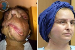 Người phụ nữ mang gương mặt quỷ trở nên xinh đẹp đến bất ngờ sau 3 năm