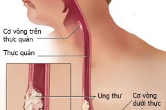 Dấu hiệu dễ thấy của ung thư thực quản