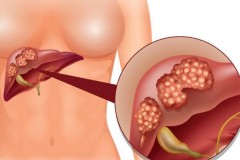 10 căn bệnh ung thư nguy hiểm nhất mọi thời đại