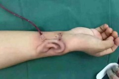 Bác sỹ Trung Quốc nuôi cấy tai trên tay bệnh nhân