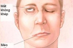 Cẩn trọng: Bỗng nhiên liệt mặt, méo miệng khi trời lạnh đột ngột