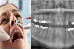 Loại thuốc điều trị Alzheimer giúp răng sâu “tự hàn”