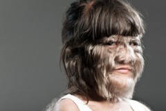 “Hội chứng người sói” có liên quan đến truyền thuyết người sói?