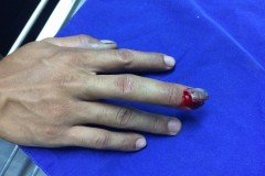 Những vụ tai nạn đứt lìa ngón tay vì vệ sinh sên không đúng cách