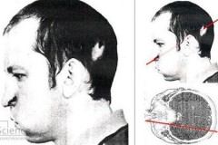 Cuộc đời người đàn ông bị chùm tia bức xạ chiếu xuyên đầu