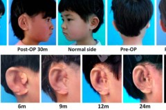 Dùng kỹ thuật in 3D, các nhà khoa học đã giúp những đứa trẻ bị dị tật bẩm sinh "mọc lại tai"