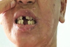 Y Nhiêu, thiếu nữ bị hành hạ tại Gia Lai sẽ được phẫu thuật thẩm mỹ, trồng răng và tạo việc làm mới