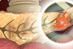 Nghiên cứu cho thấy vắc-xin mRNA có thể ngăn chặn ung thư tuyến tụy
