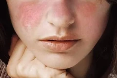 Các nhà khoa học cuối cùng đã xác định được nguyên nhân di truyền của bệnh lupus