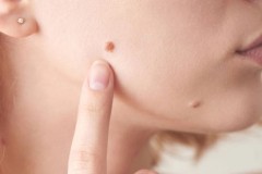 Nốt ruồi ở má có ý nghĩa gì? Là điềm báo tốt hay xấu?