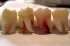 Răng “khôn” gây tử vong và mối nguy hiểm không phải ai cũng biết