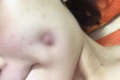 Chỉ vì hút mụn, cô gái này có nguy cơ mặt bị hoại tử, biến dạng