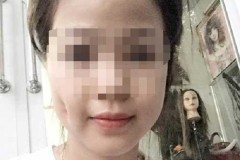 Mặt sưng vù vì làm má lúm đồng tiền giá rẻ