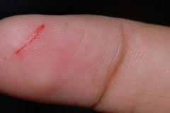 Báo động căn bệnh gây tử vong từ 1 vết xước nhỏ