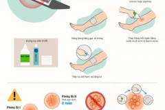 Cách xử lý khi bị bỏng bô xe máy