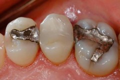 Hàn răng nhiều lần sẽ khiến bạn nhận một kết cục vô cùng đáng sợ