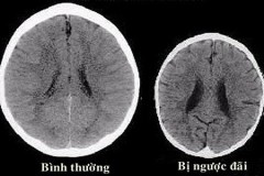Trẻ em bị cha mẹ ngược đãi dễ bị teo não