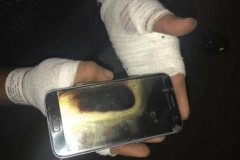 Một người đàn ông bị bỏng khá nặng do Galaxy S7 phát nổ trên tay