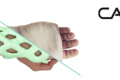 Bó bột kiểu mới với Cast 21: nhẹ hơn, nhanh hơn, đơn giản hơn.