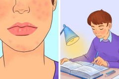 [Cuộc sống] Nghiên cứu mới: Đa phần những ai bị mụn ở tuổi dậy thì sẽ thành công
