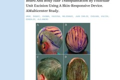 Công nghệ mới sử dụng râu và các loại lông tóc khác của cơ thể cho phép thay đổi việc chữa trị chứng rụng tóc