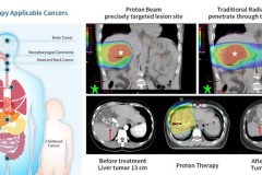 Liệu pháp proton điều trị ung thư của bệnh viện Chang Gung đạt được bước đột phá