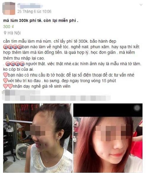 Mặt sưng vù vì làm má lúm đồng tiền giá rẻ