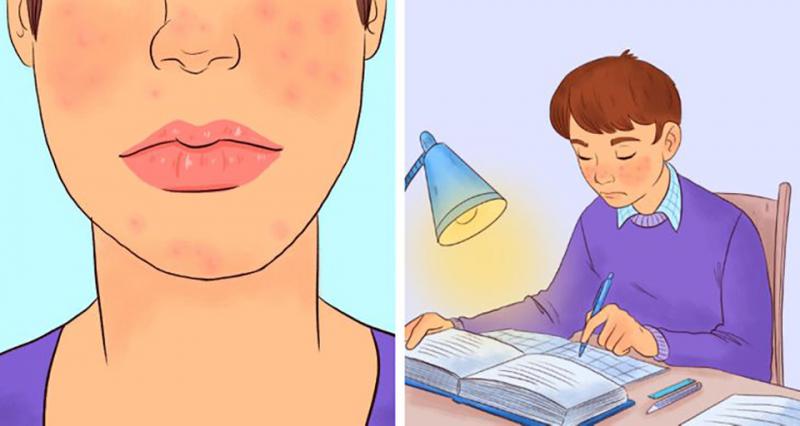 [Cuộc sống] Nghiên cứu mới: Đa phần những ai bị mụn ở tuổi dậy thì sẽ thành công